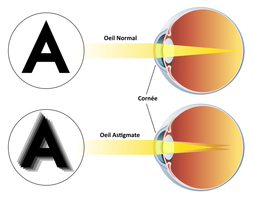 Schéma d'un œil astigmate