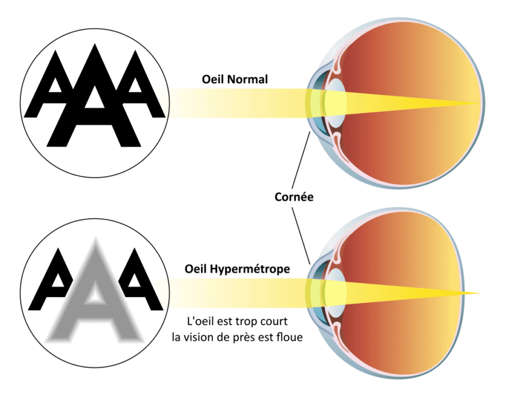 Schéma d'un œil hypermétrope