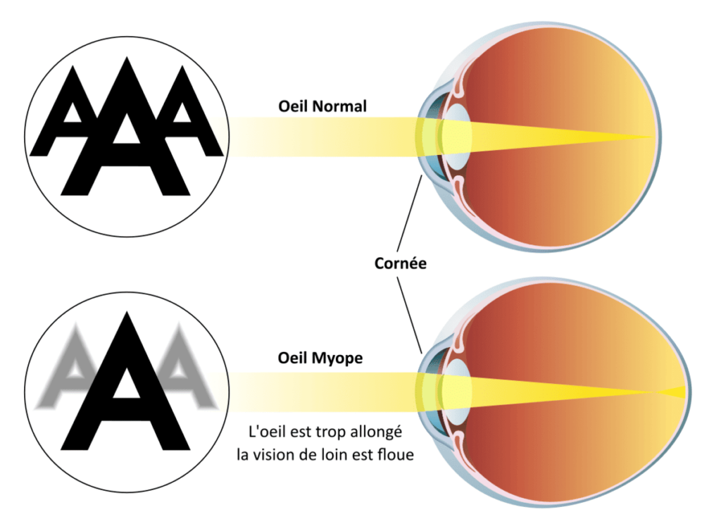 schéma d'un œil myope