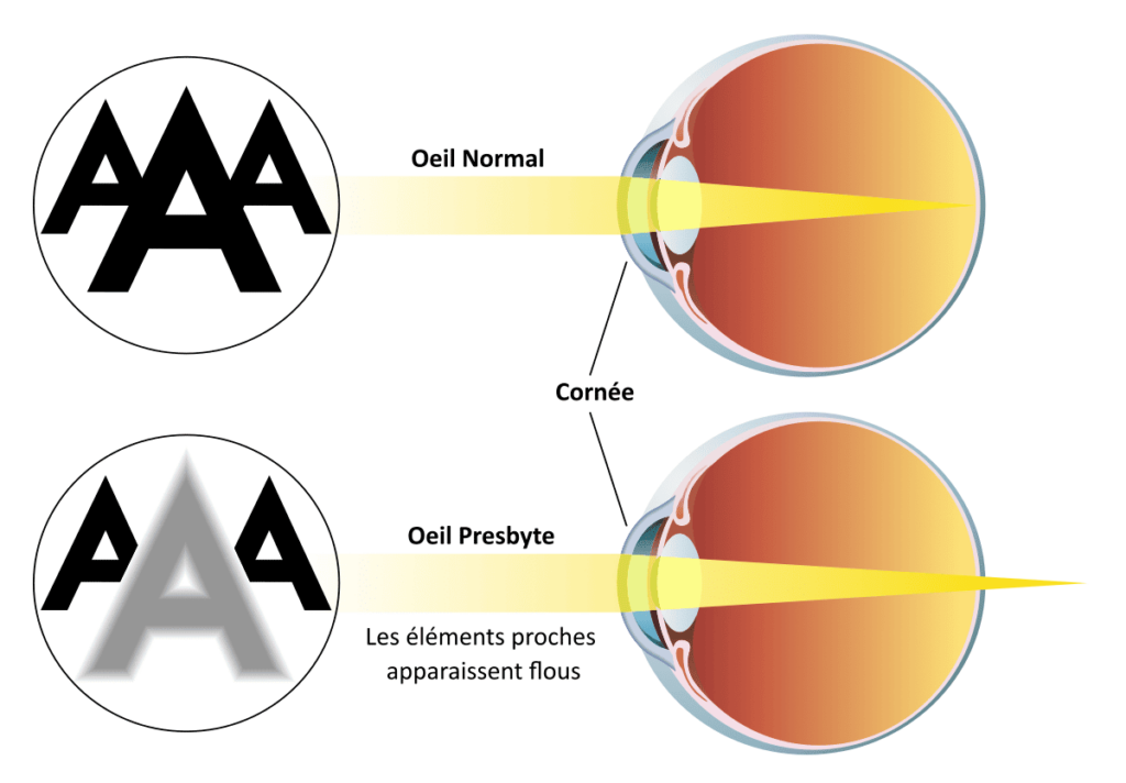 Schéma d'un œil presbyte