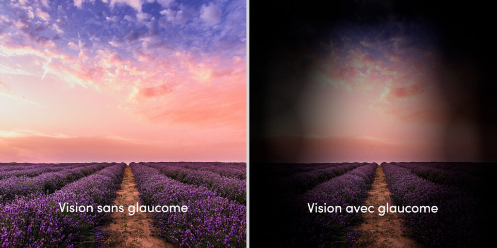 Comparatif de la vision sans glaucome (à gauche) et d'une vision avec glaucome (à droite). 