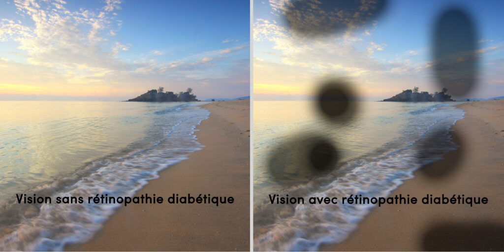Comparatif d'une vision sans rétinopathie diabétique (à gauche) avec une vision avec rétinopathie diabétique (à droite). 